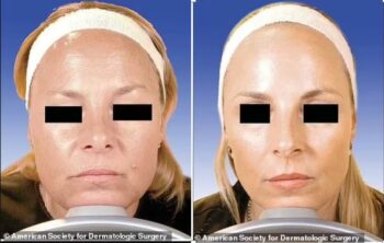 Ενέσεις Botox για 20 χρόνια - TechFreak.GR